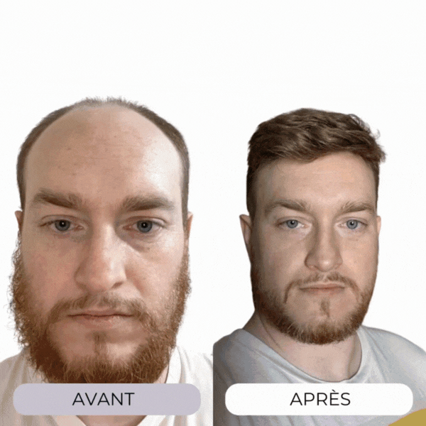 Technologie Capillaire
Micro-infuse® Homme