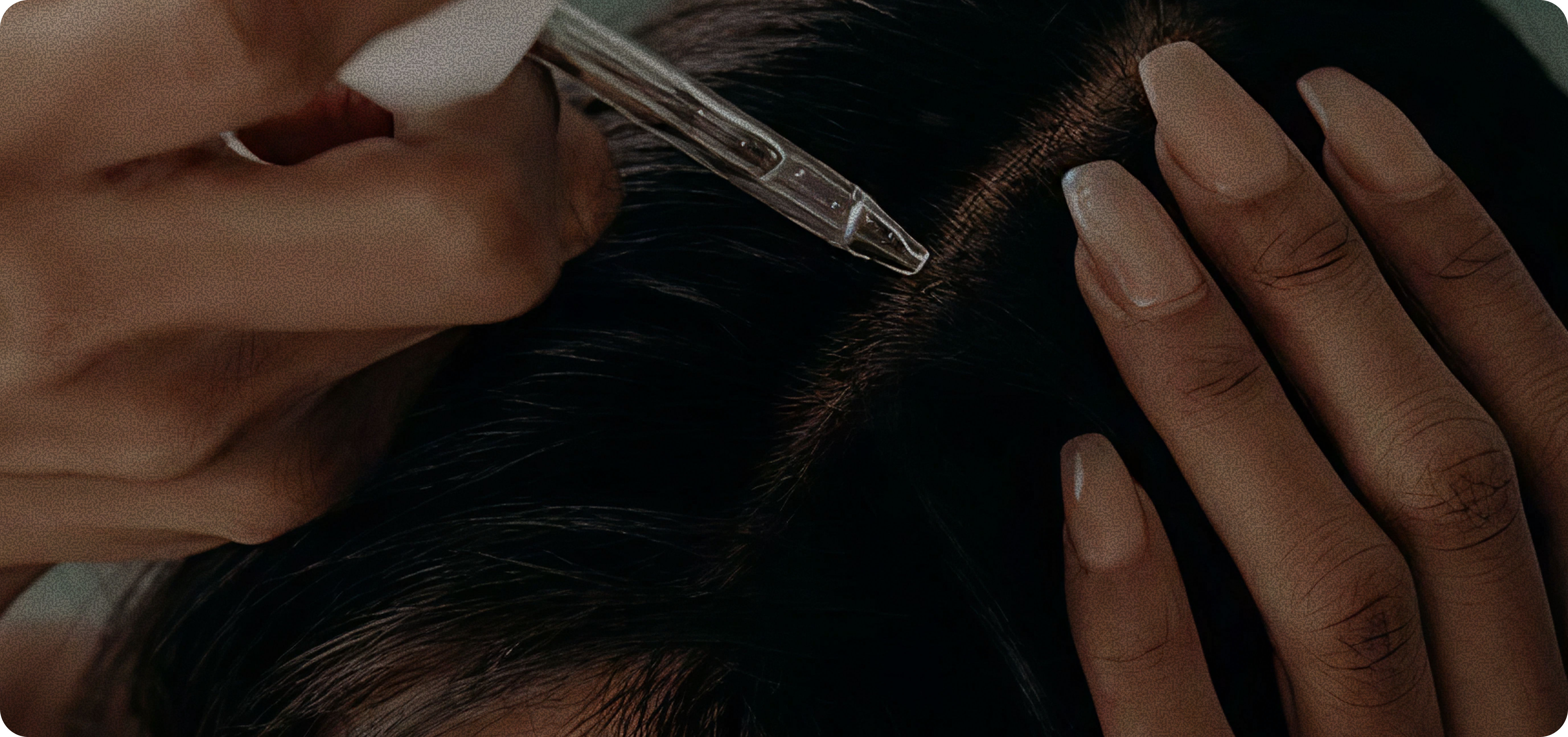 Traiter les causes profondes de la chute capillaire féminine, en une approche complète.