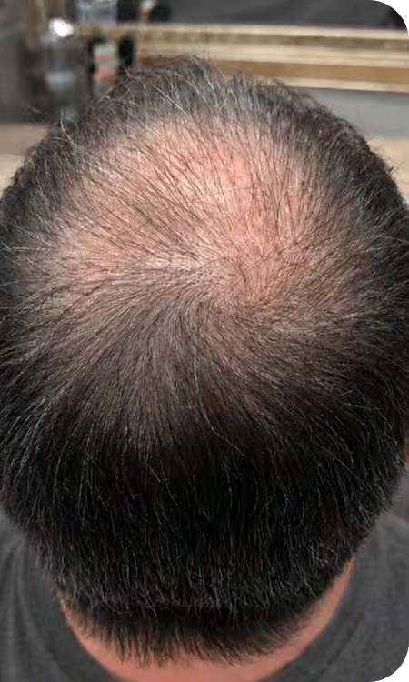 Couronne redensifiée