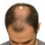 Sommet du crâne (tonsure)