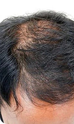 Cheveux préservés à temps
