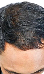 Cheveux préservés à temps